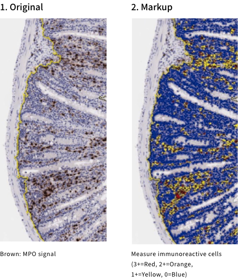 1. Original2. MarkupBrown: MPO signalMeasure immunoreactive cells (3+=Red, 2+=Orange, 1+=Yellow, 0=Blue)